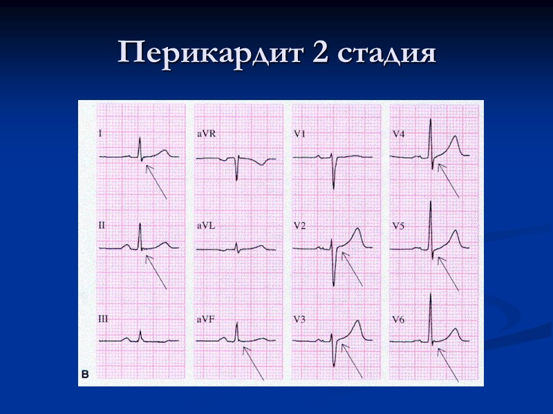 Перикардит 2 стадия